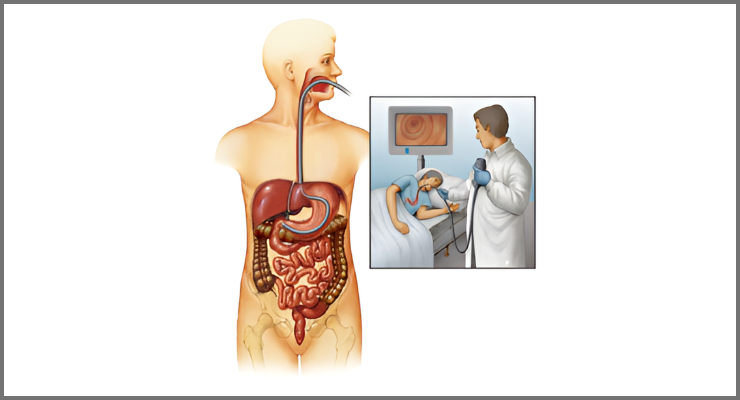 Endoscopy Gastroscopy