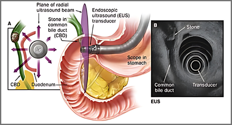 Endoscopy Ultrasound (EUS)