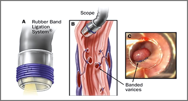 Variceal band ligation or banding